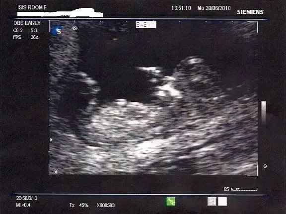 ultra-sound-Jen