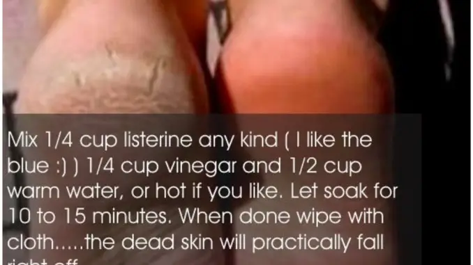 dry-cracked-heals